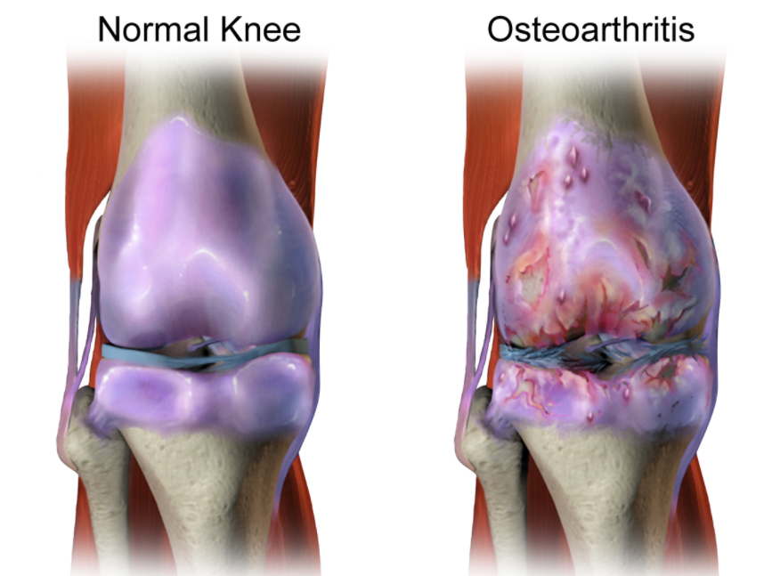 Osteoarthritis Treatment Brisbane