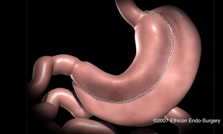 gastric sleeve