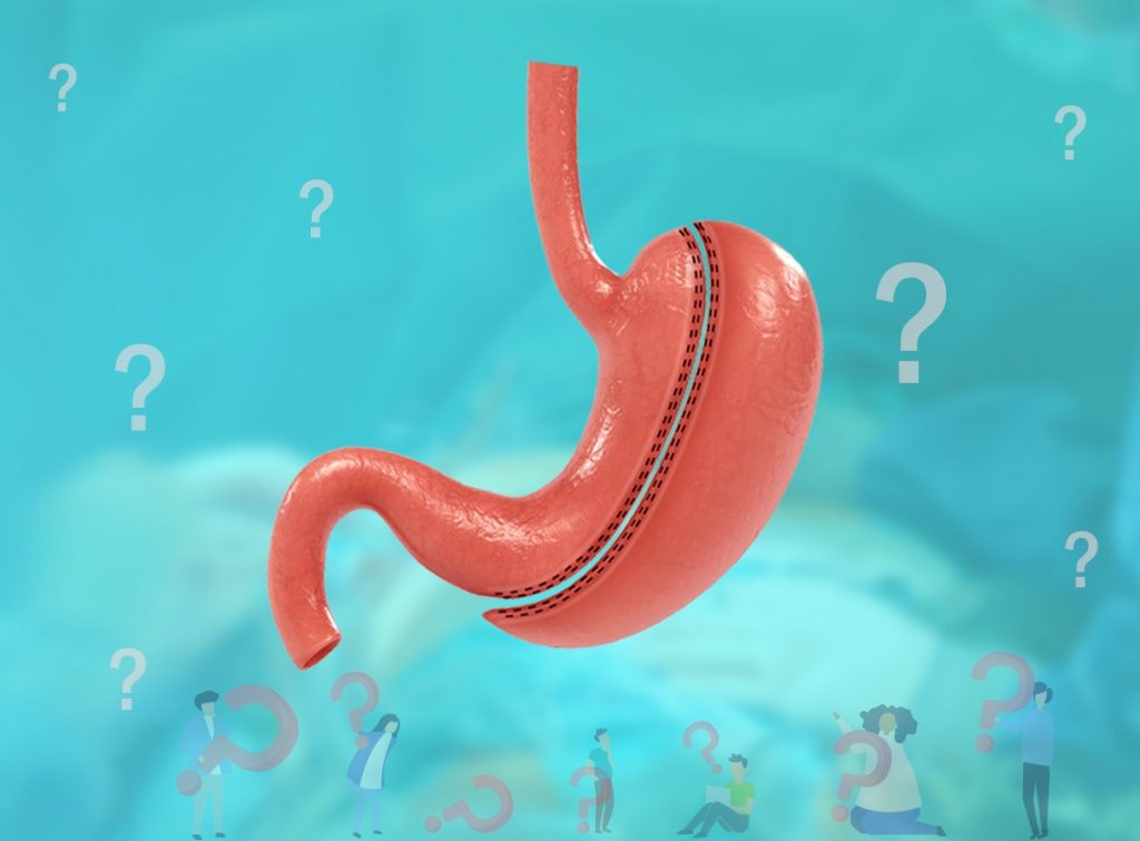 gastric sleeve