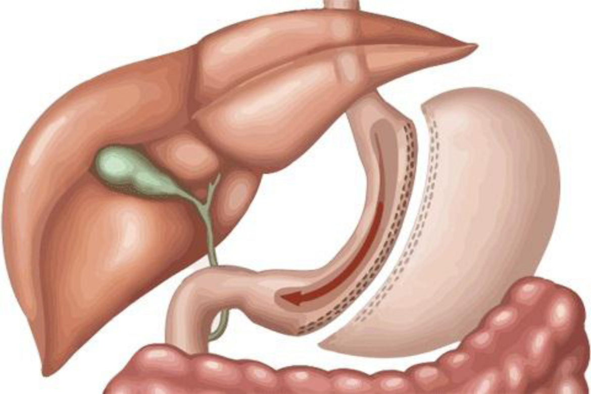 gastric sleeve operation