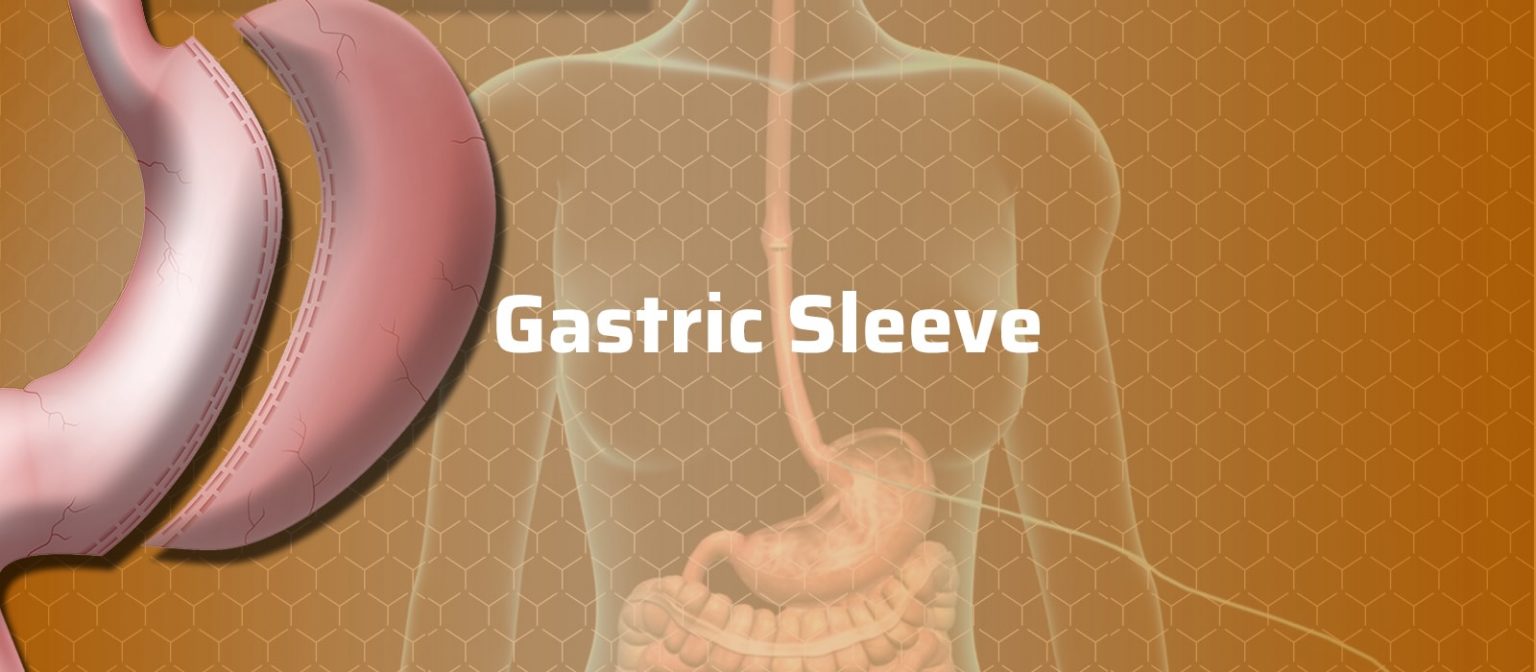 gastric sleeve operation
