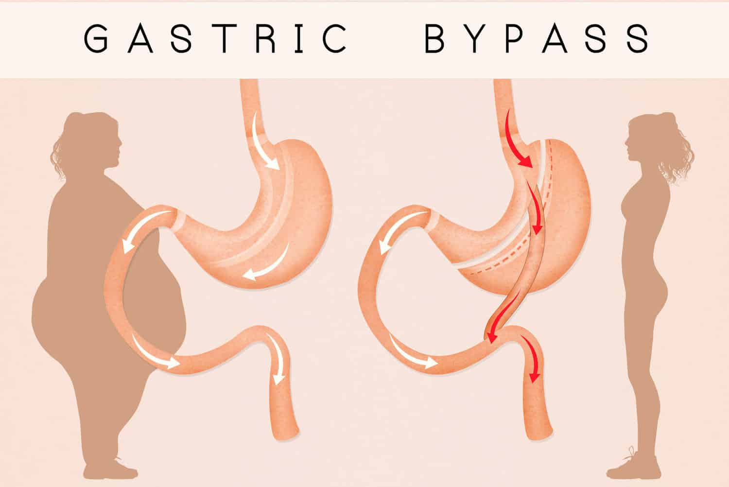 gastric bypass to reduce stomach