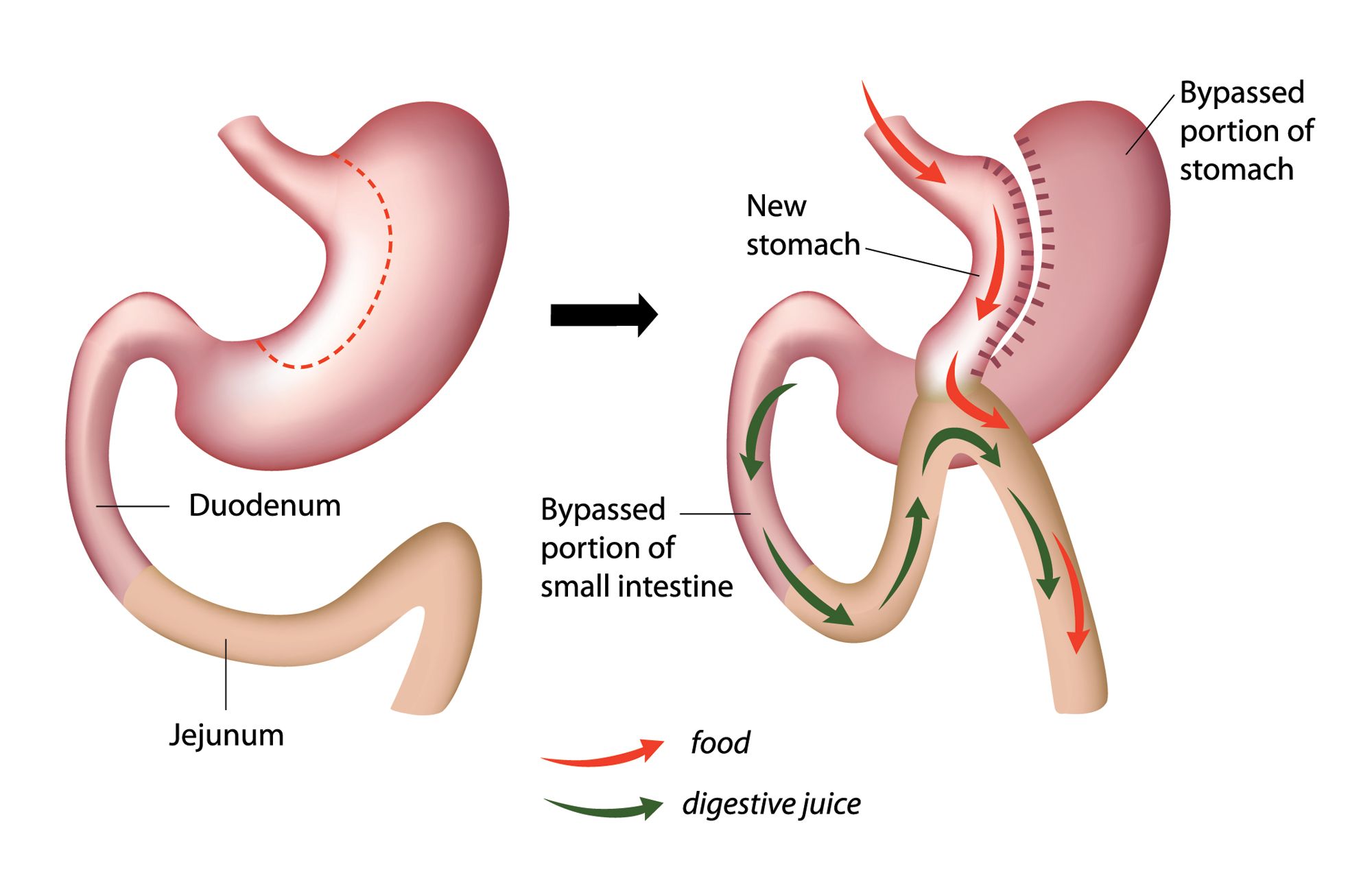 gastric bypass to reduce stomach