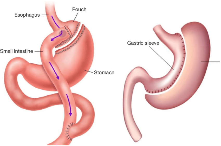 gastric bypass sleeve